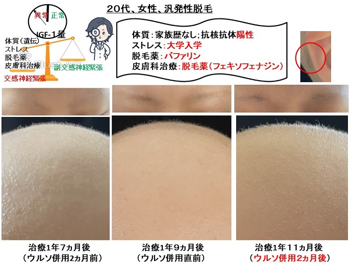円形脱毛症　病院